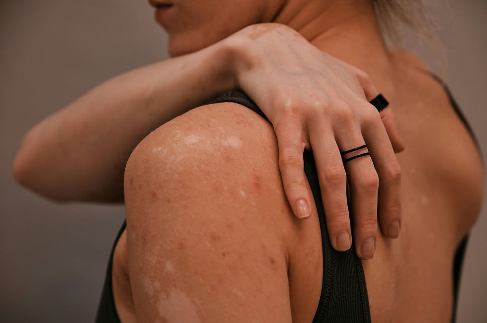 Close-up of a person with vitiligo patches, hand resting on their shoulder, wearing a black strap against a soft neutral background