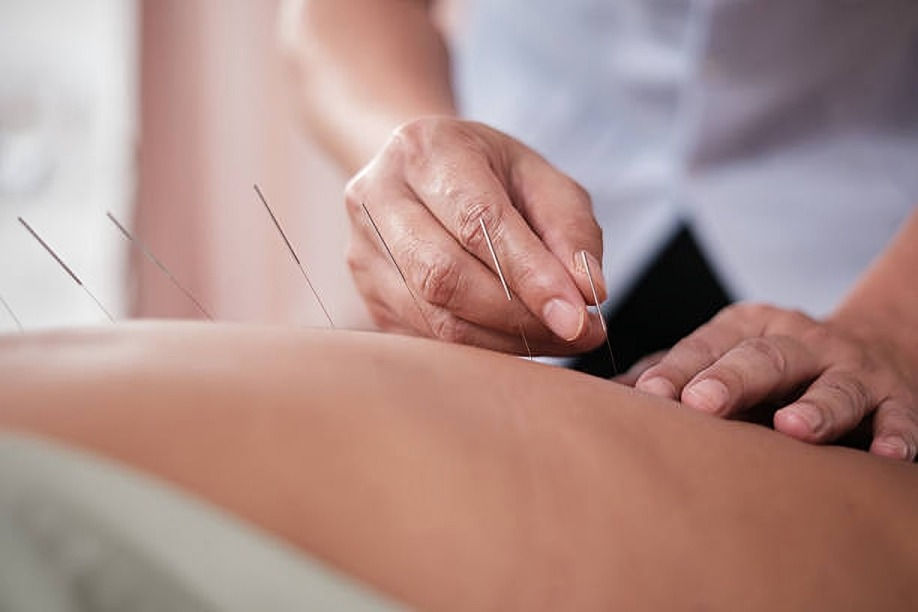 Close-up of an acupuncturist inserting thin needles into a person's bare back in a calm treatment room