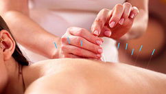 Evidence-Based Acupuncture for Chronic Pain as a Modern Approach to Non-Drug Pain Relief