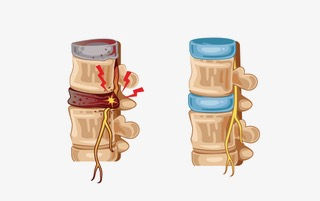 Two cartoon spines on white: left has a painful red injury and lightning bolt, right is healthy with blue discs.